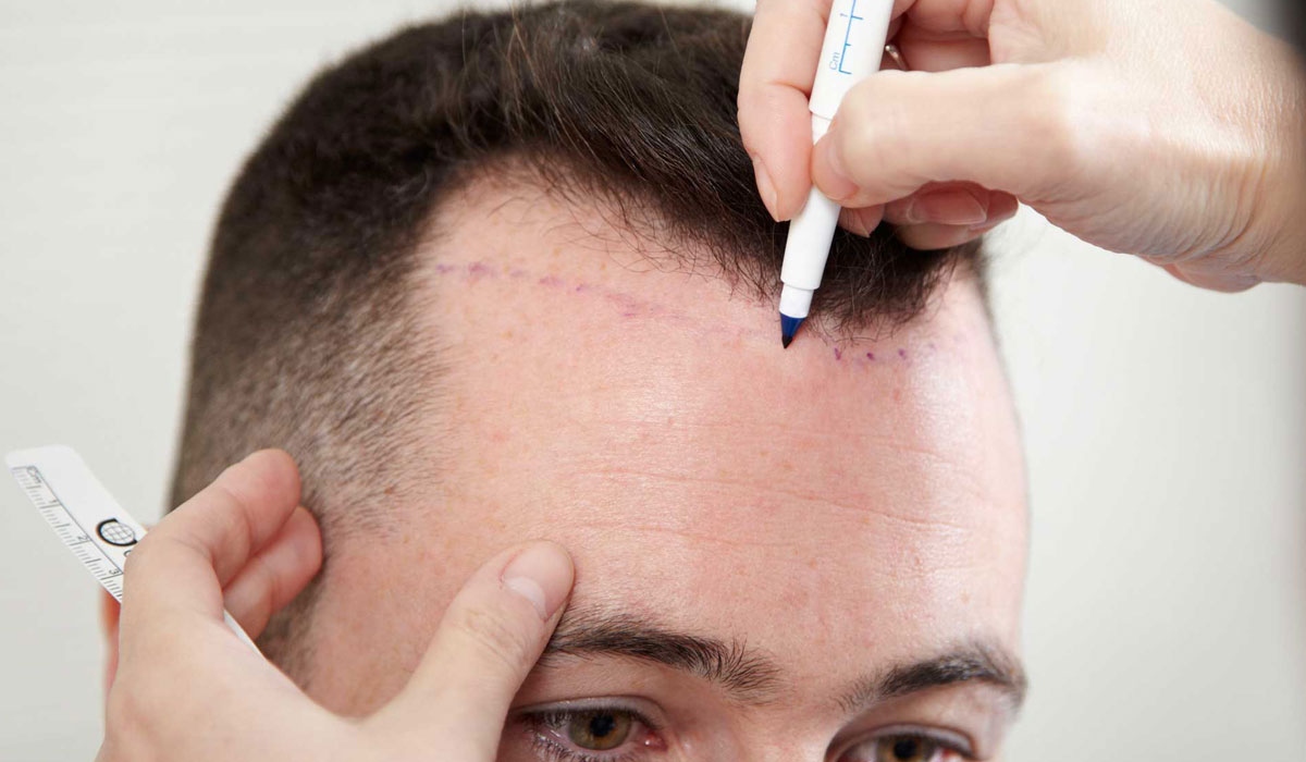 فوائد زراعة الشعر , تعرف علي الحالات التي يتم فيها اللجوء الي زراعه الشعر وماهي فوائدها