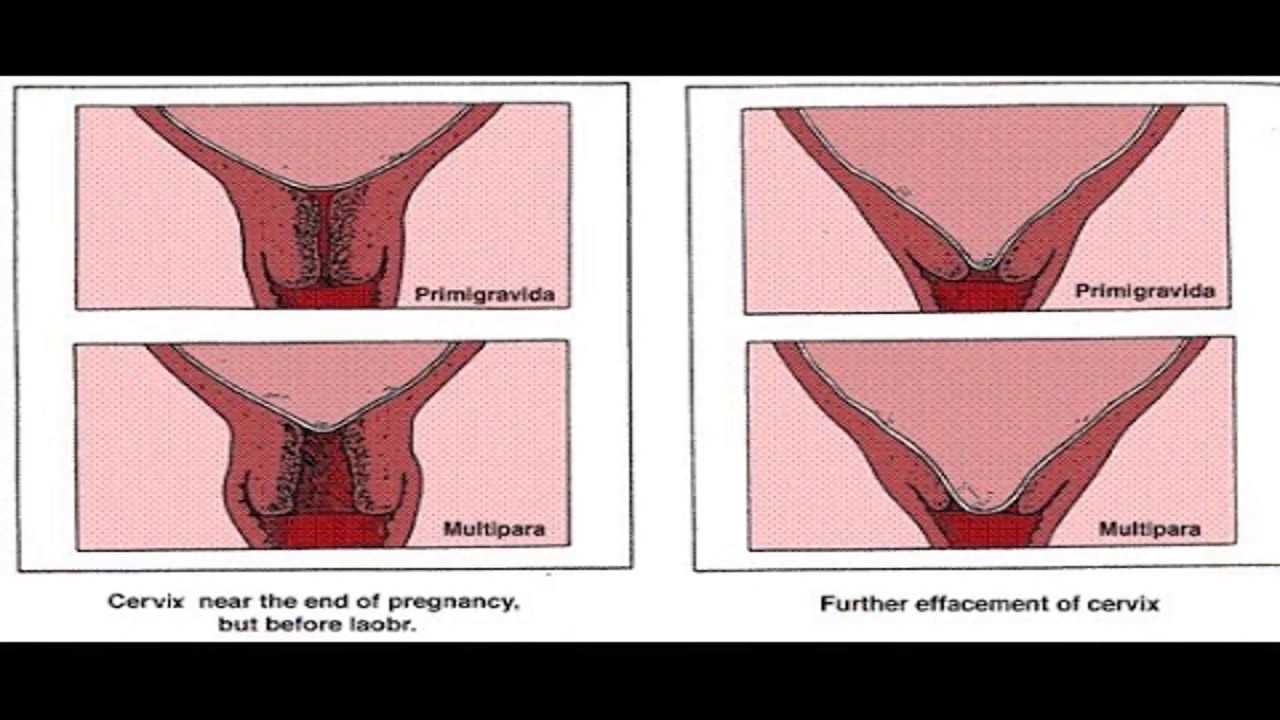 كيف اعرف ان عنق الرحم مفتوح في الشهر التاسع , سبب فتح عنق الرحم
