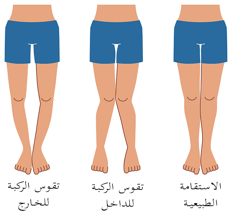 علاج التقوس عند الاطفال , ماذا افعل اذا كان ابنى رجليه مقوسه