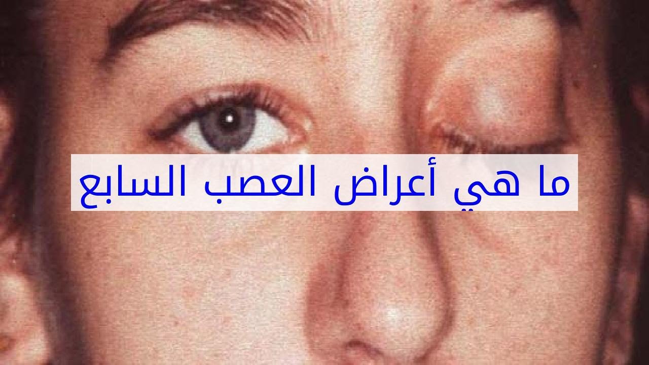 اعراض العصب السابع , كيف اعرف اني مصاب بالعصب السابع