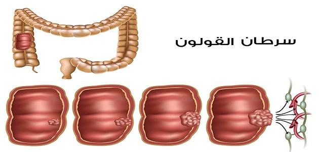 تجربتي مع سرطان القولون , ممكن نتكلم عن السرطان