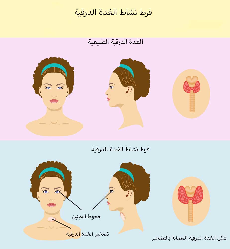 اعراض زيادة الغدة الدرقية , زيادة افراز الغدة الدرقيه واعراضها