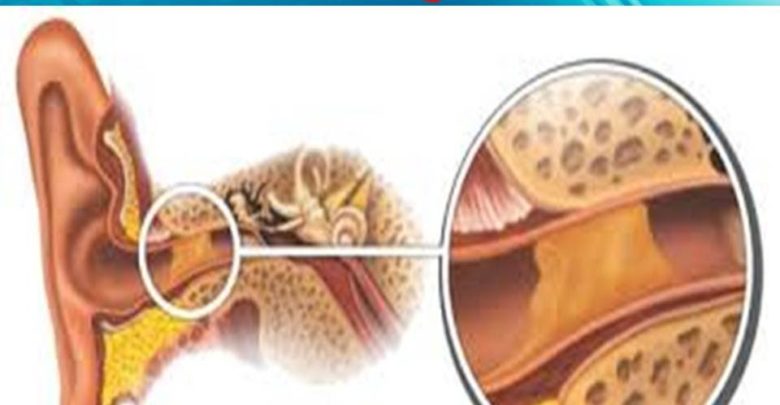 اسباب تسكير الاذن , سبب انسداد الاذن