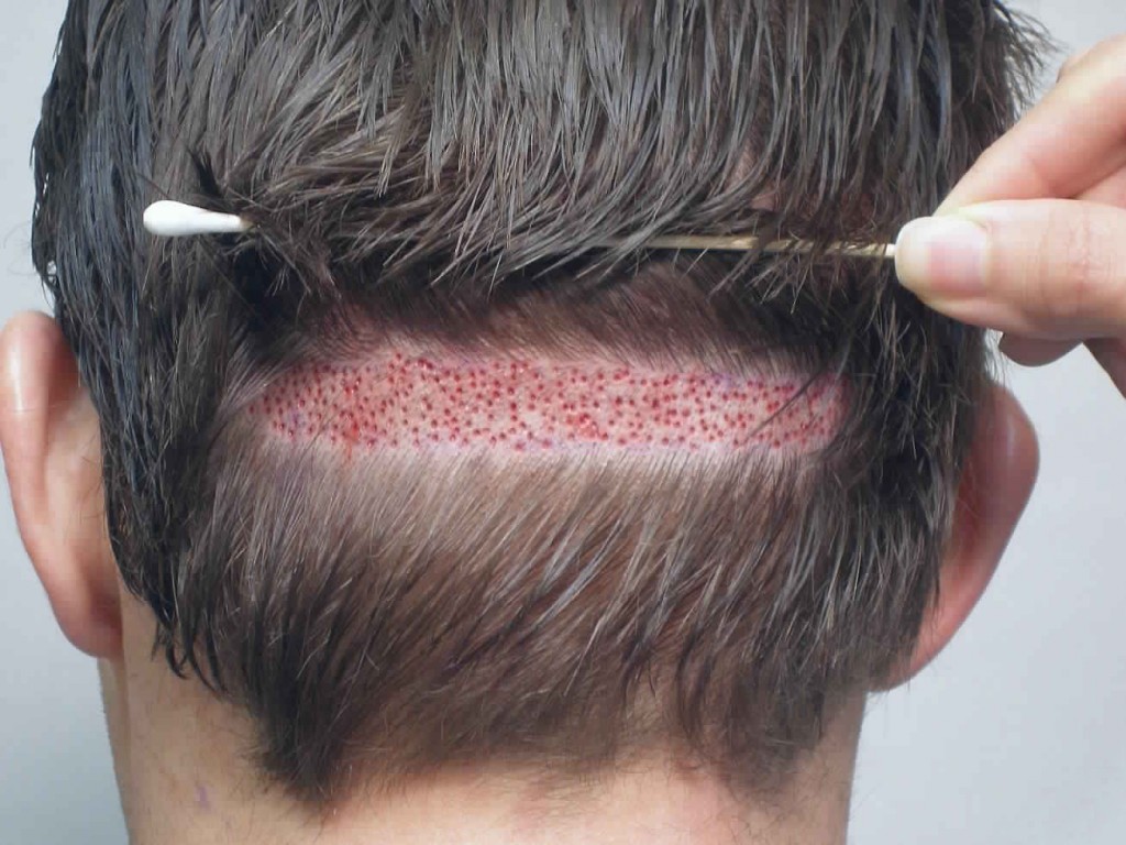 تجربتي في زراعة الشعر , طرق زراعة الشعر