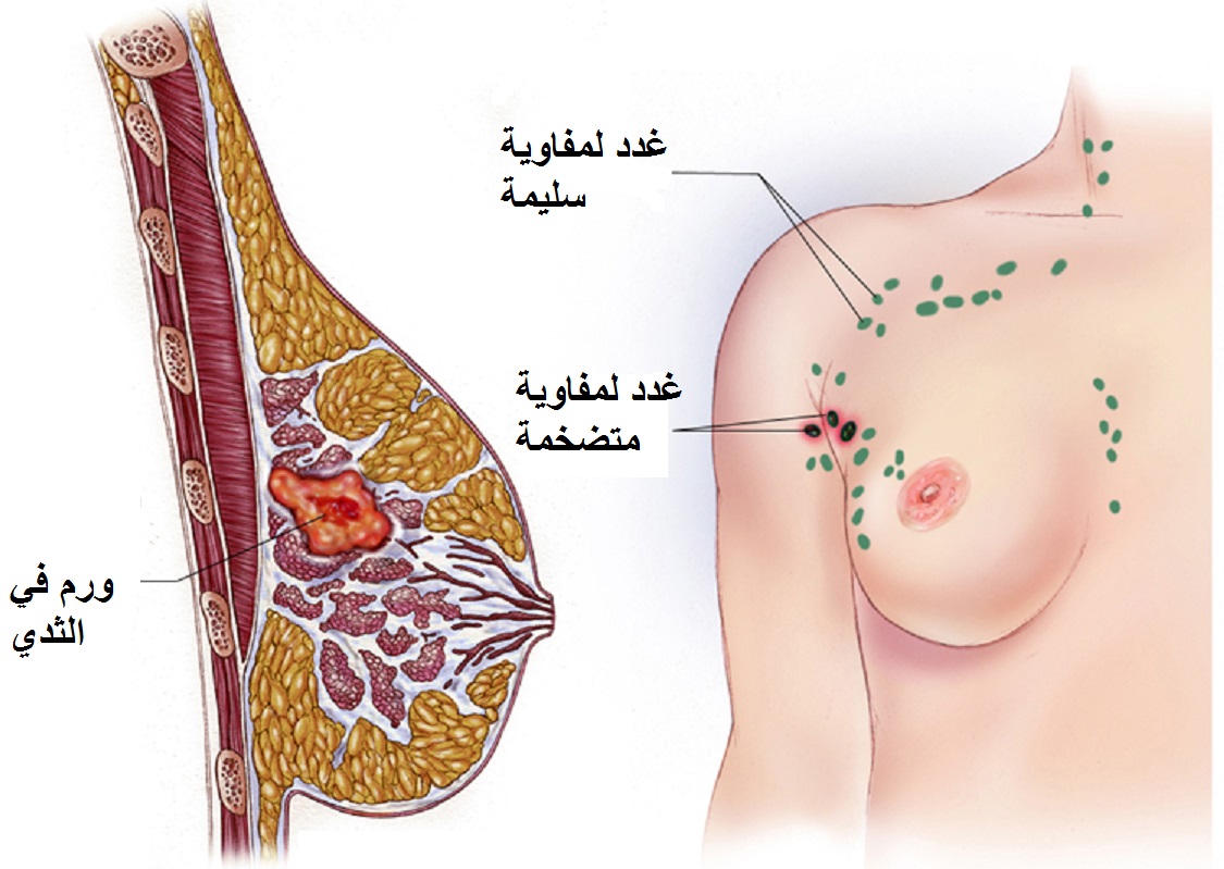 تشخيص سرطان الثدي , اكتشفي سرطان الثدي في مراحله المبكرة